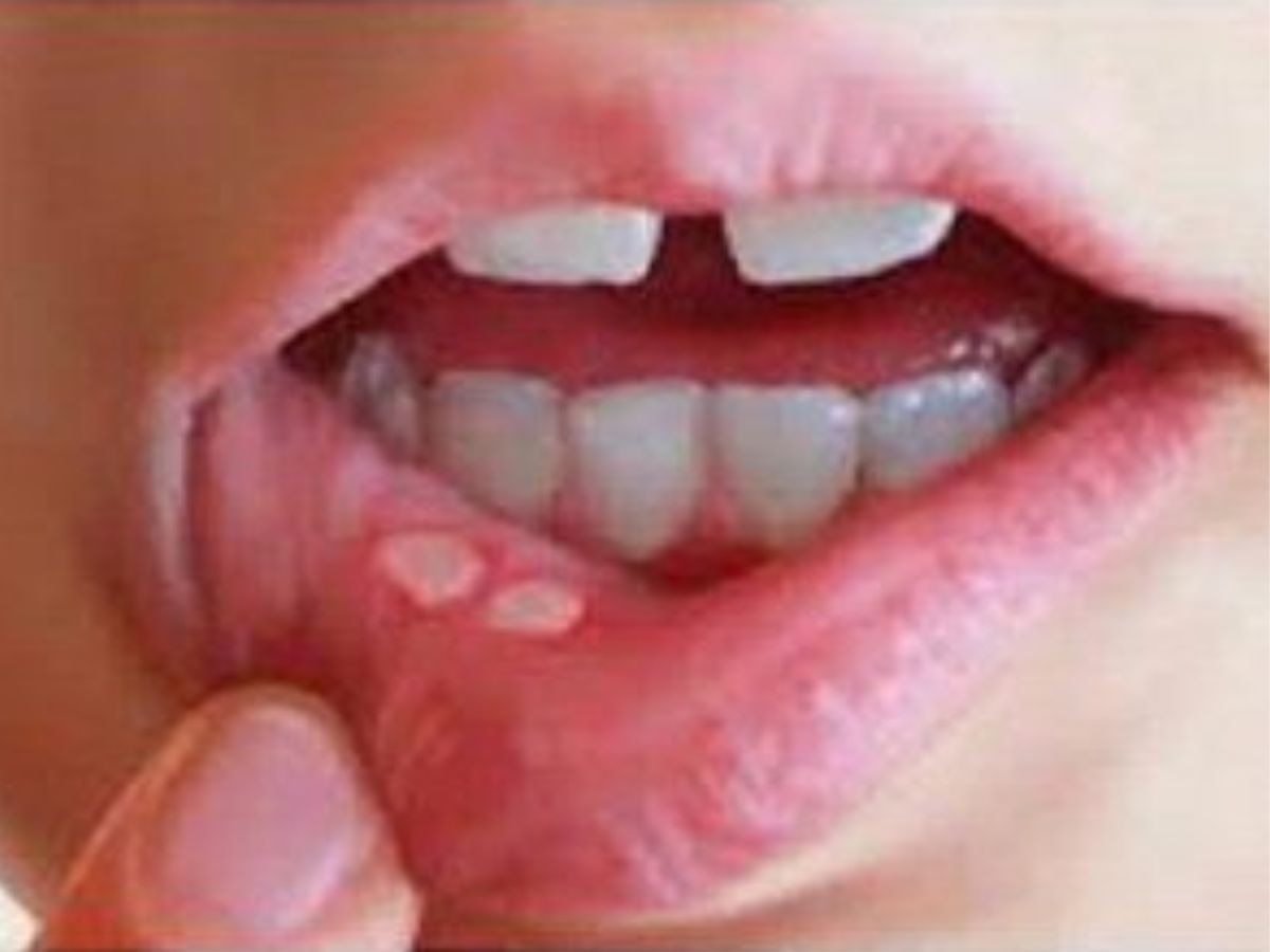 Mouth Ulcer: तोंड आलंय, फोडांमुळं अन्न खातानाही त्रास होतोय? हे' घरगुती उपाय क्षणात देतील आराम title=