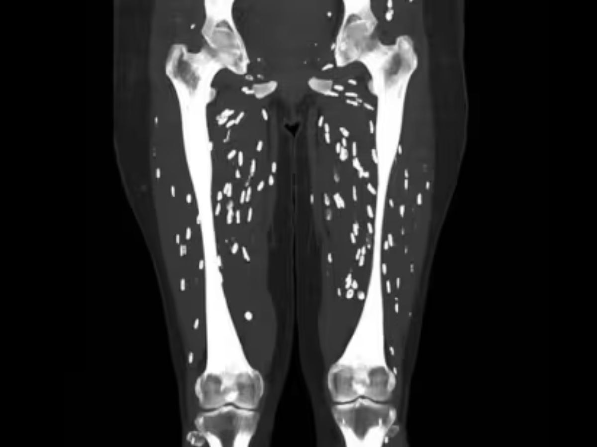 CT Scan च्या रिपोर्टमध्ये दिसले गुडघ्यातले किडे; आहारातील ‘या’ चुकीमुळं ओढावलं संकट