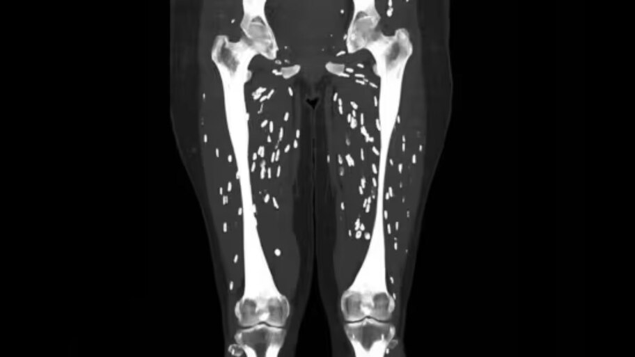 CT Scan च्या रिपोर्टमध्ये दिसले गुडघ्यातले किडे; आहारातील 'या' चुकीमुळं ओढावलं संकट