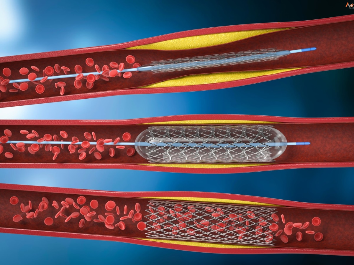 Uddhav Thackeray Heart difference between angiography and angioplasty Health Marathi News