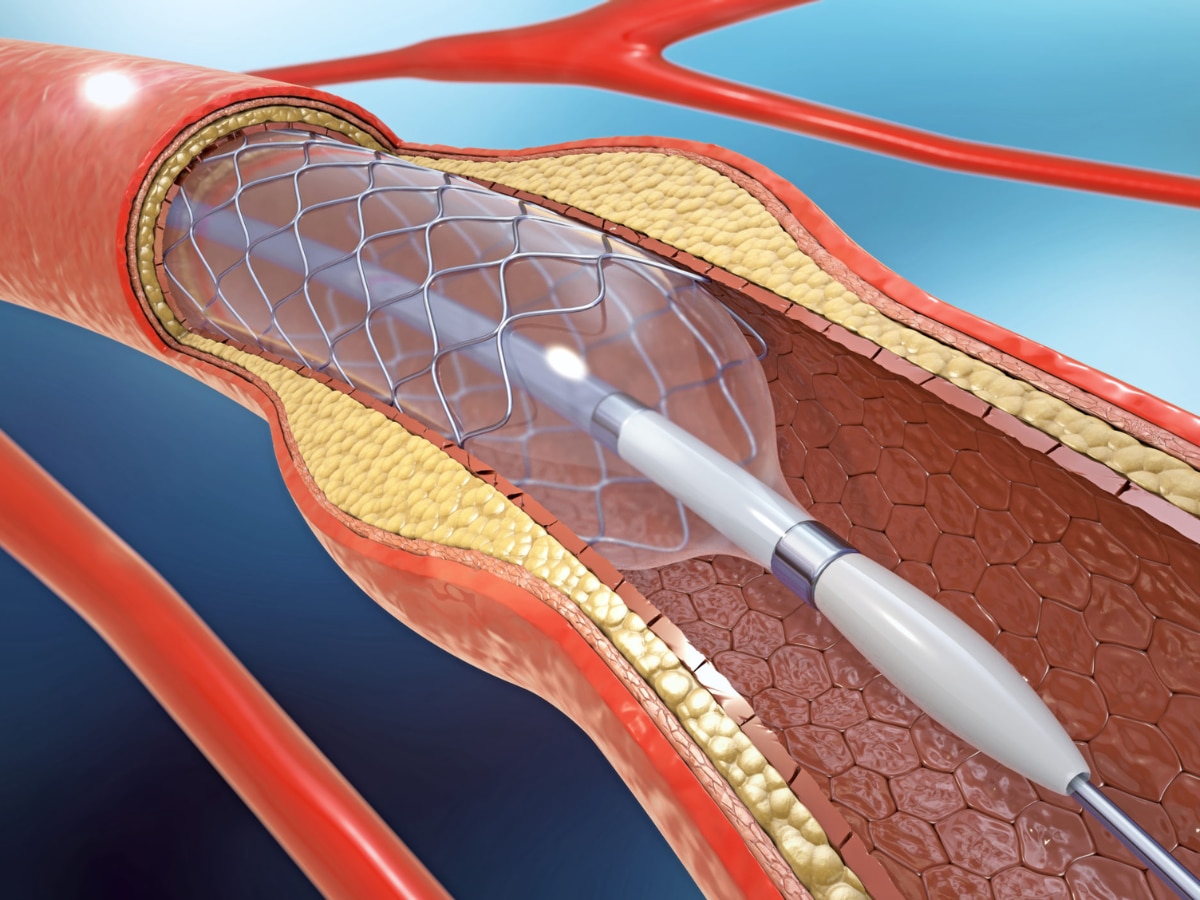 Uddhav Thackeray Heart difference between angiography and angioplasty Health Marathi News