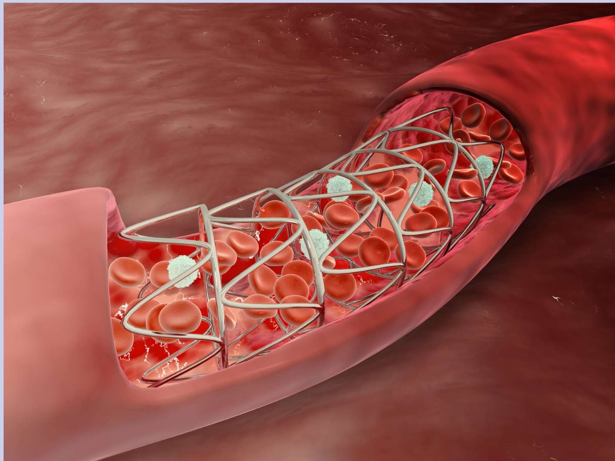 Uddhav Thackeray Heart difference between angiography and angioplasty Health Marathi News