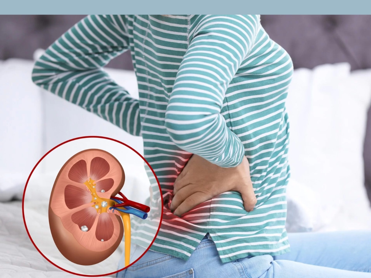 Kidney Stones च्या रुग्णांनी 'हे' 5 पदार्थ खाण्याचा स्वप्नातही विचार करु नका, अन्यथा...! title=