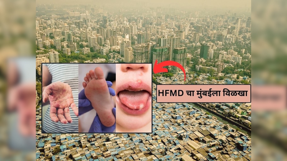 लहान मुलांमध्ये पसरतोय 'हॅन्ड फूट माउथ डिसीज', लक्षणे आणि कारण जाणून घ्या?
