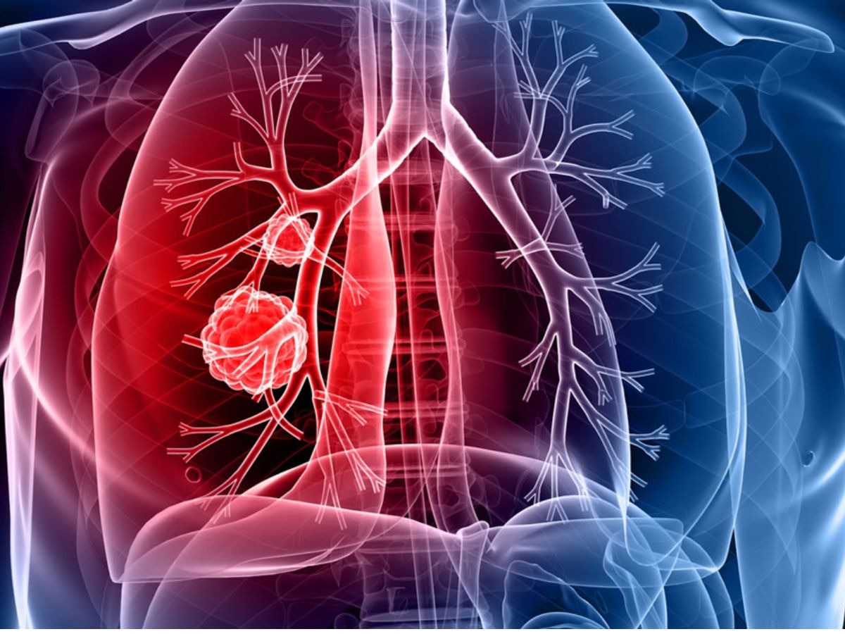 फुफ्फुसाचा कर्करोग 5 सेकंदात कसं ओळखाल, घरच्या घरी करा ही सोपी टेस्ट title=