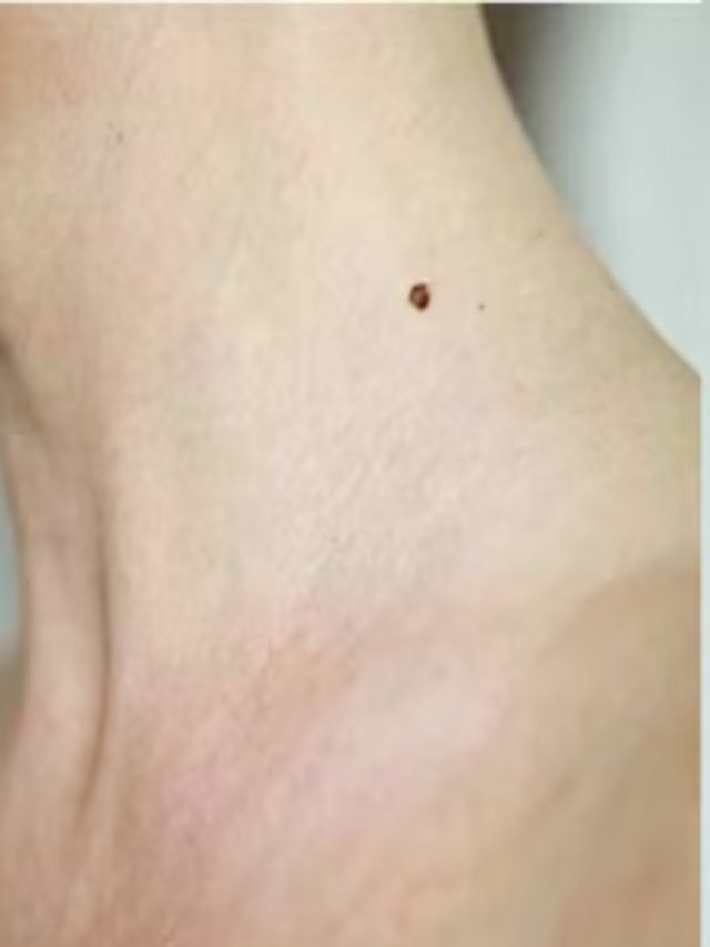 Having A Mole On neck reveal about your  Personality 