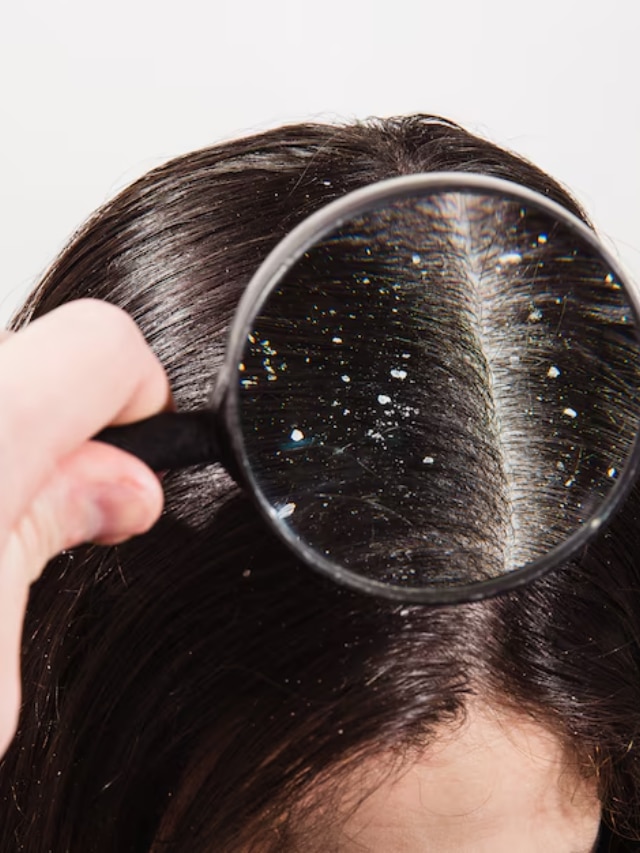 How to remove dandruff at home remedies know tricks 