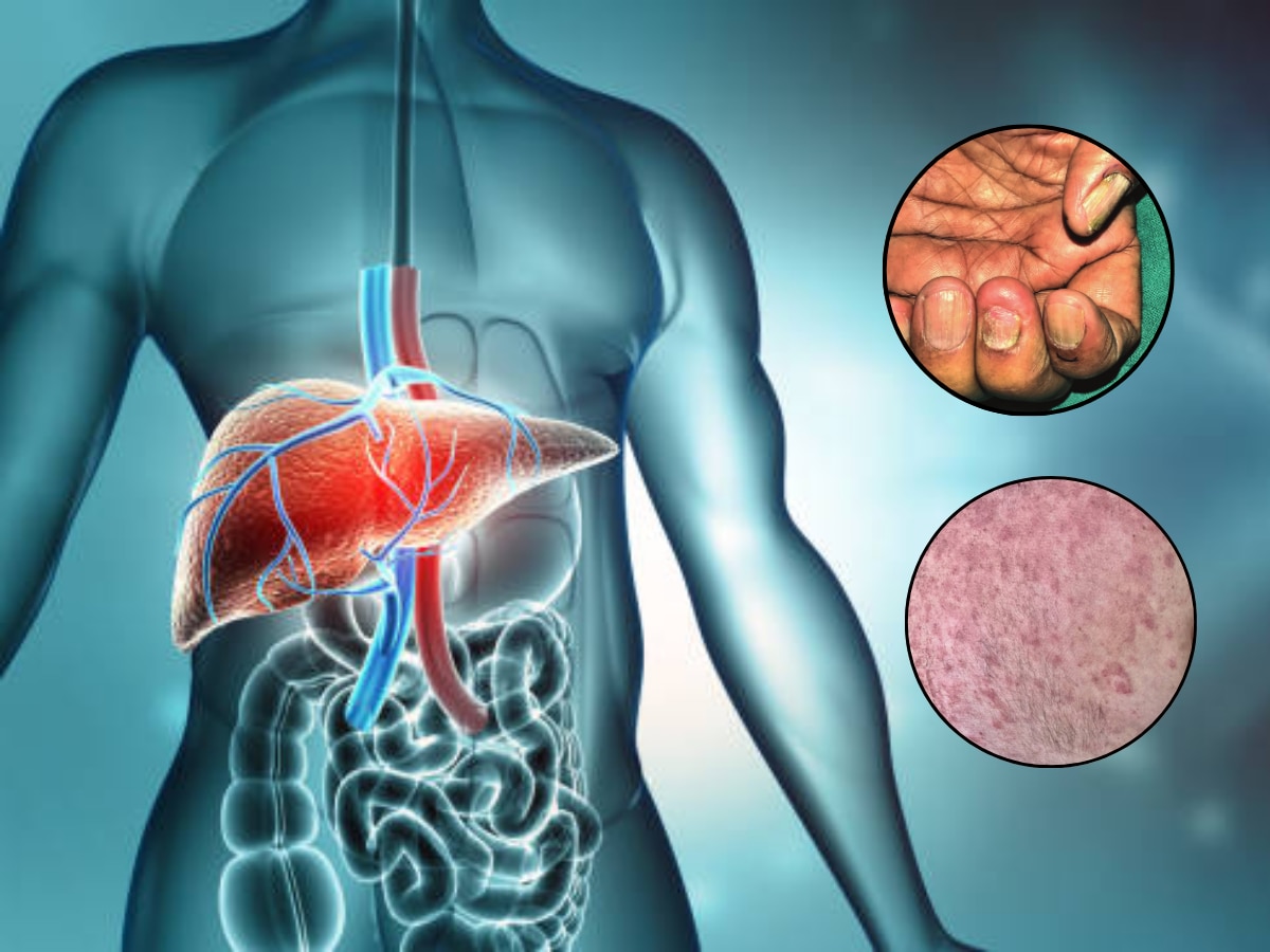 लिव्हर खराब झाल्यामुळे त्वचा आणि नखांवर दिसतात 'ही' 4 लक्षणे; दुर्लक्ष करणं महागात पडेल  title=