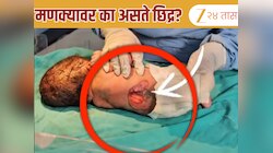 जन्मतःच बाळाच्या पाठीवर छिद्र; आईच्या एका चुकीमुळे नवजात बाळाची 'ही' अवस्था; डॉक्टरांनी सांगितलं कारण 