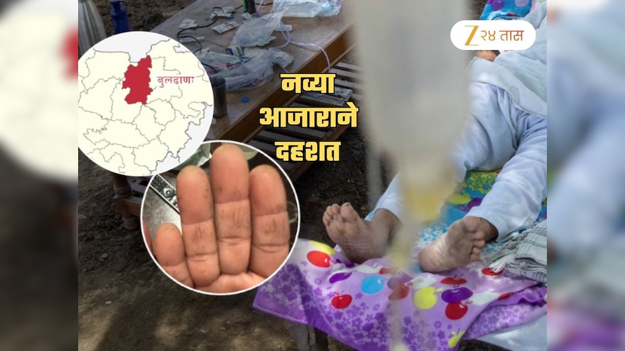 बुलढाण्यात पुन्हा रहस्यमय आजाराचं थैमान! हातांवर दिसतायेत लक्षणं; तातडीने डॉक्टरांचं विशेष पथक रवाना