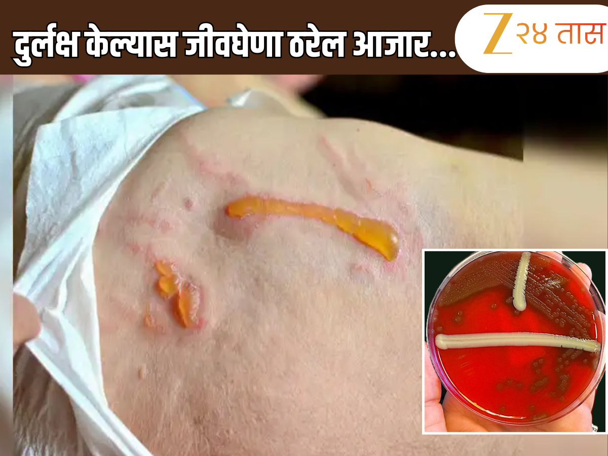 'या' आजारात सडतात शरीरातील काही भागांमधील टिश्यू, काय आहे गंभीर आजाराची लक्षणे 'या' आजारात सडतात शरीरातील काही भागांमधील टिश्यू, काय आहे गंभीर आजाराची लक्षणे