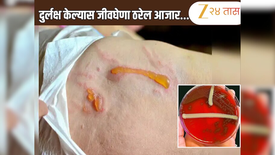 'या' आजारात सडतात शरीरातील काही भागांमधील टिश्यू, काय आहे गंभीर आजाराची लक्षणे 