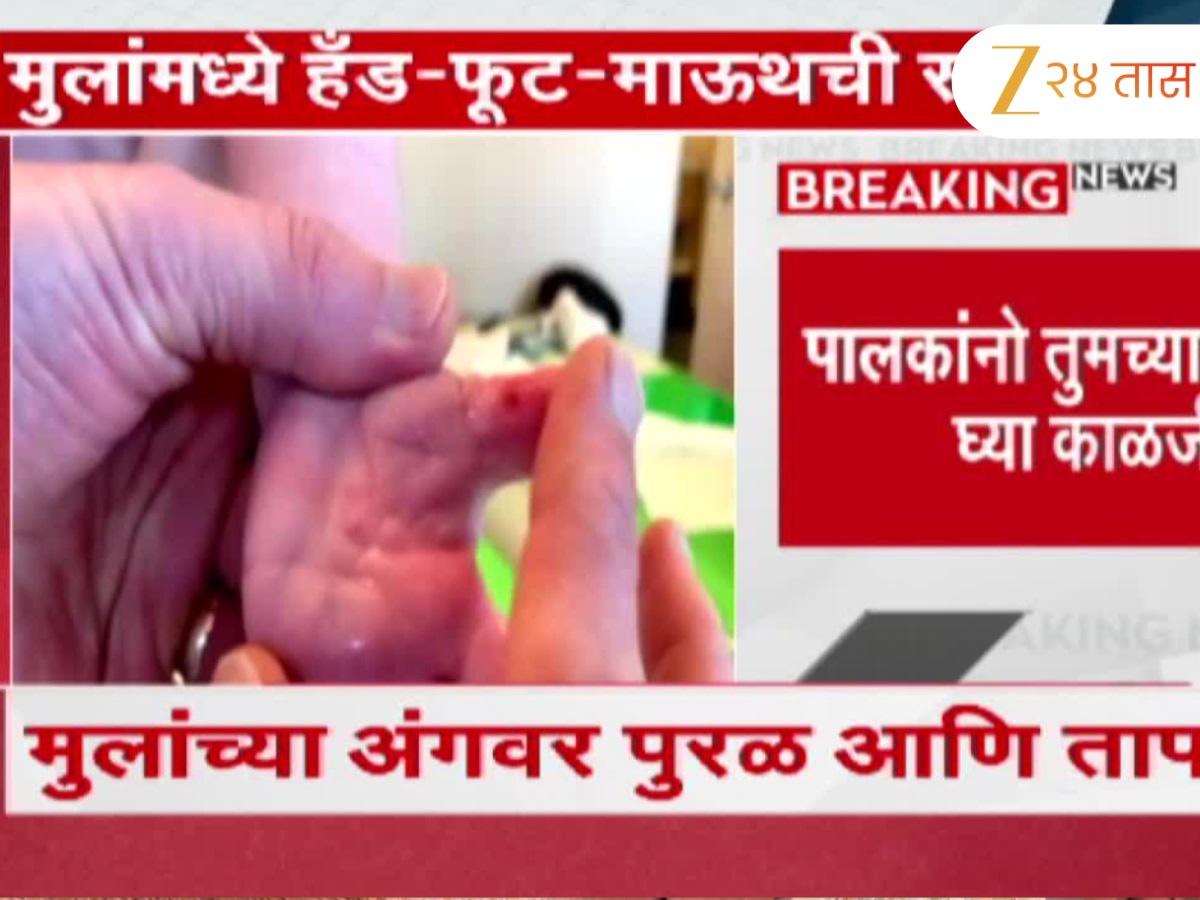 लहान मुलांना ‘हॅन्ड, फूट, माऊथ’ डिसिजचा विळखा लहान मुलांना ‘हॅन्ड, फूट, माऊथ’ डिसिजचा विळखा