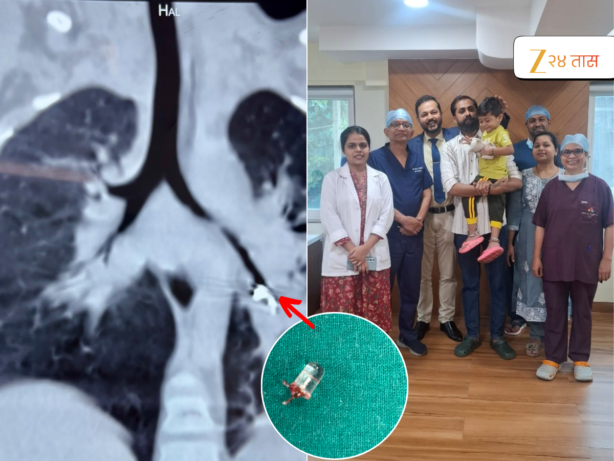 साडेतीन वर्षांच्या मुलाच्या फुफ्फुसात LED बल्ब, डॉक्टरांच्या प्रयत्नांनी चिमुकला बचावला, पण बल्ब आत गेलाच कसा? साडेतीन वर्षांच्या मुलाच्या फुफ्फुसात LED बल्ब, डॉक्टरांच्या प्रयत्नांनी चिमुकला बचावला, पण बल्ब आत गेलाच कसा?
