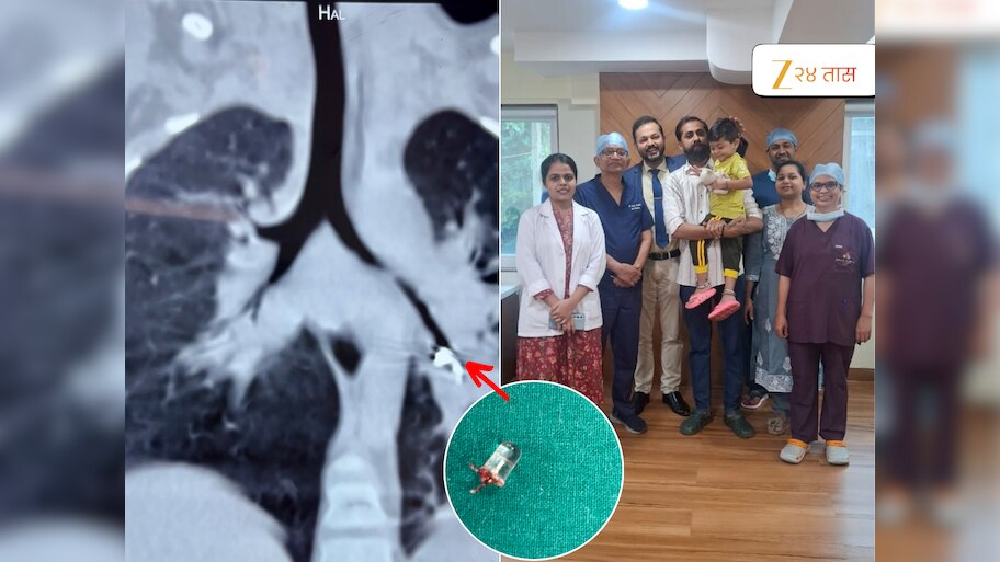 साडेतीन वर्षांच्या मुलाच्या फुफ्फुसात LED बल्ब, डॉक्टरांच्या प्रयत्नांनी चिमुकला बचावला, पण बल्ब आत गेलाच कसा?