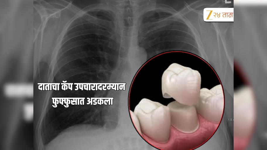 सतर्क राहा! उपाचारावेळी दाताची कॅप थेट रुग्णाच्या फुफ्फुसात