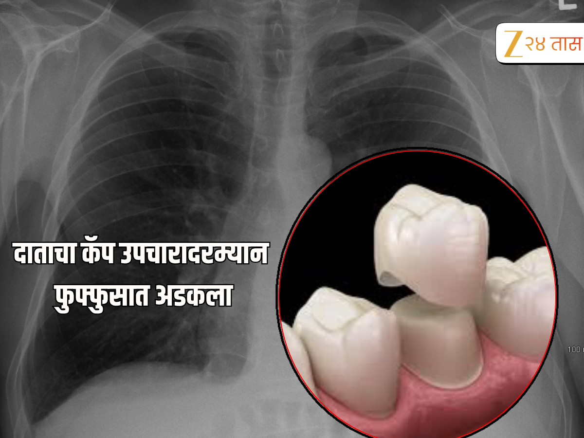 सतर्क राहा! उपाचारावेळी दाताची कॅप थेट रुग्णाच्या फुफ्फुसात सतर्क राहा! उपाचारावेळी दाताची कॅप थेट रुग्णाच्या फुफ्फुसात