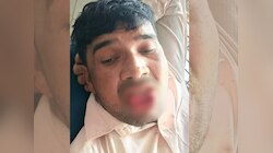 एक्स गर्लफ्रेंडच्या किससाठी तरुणाने आयुष्य लावलं पणाला; आता आयुष्यभर बोलू शकणार नाही एकही शब्द