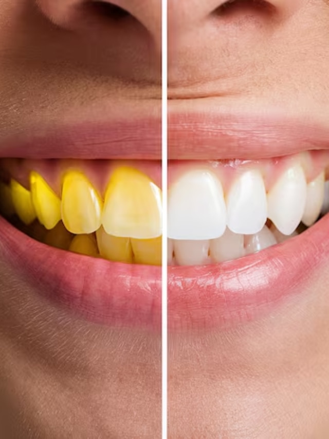 दातांचा पिवळेपणा कसा दूर करावा?