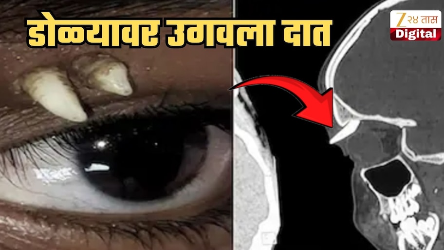 Medical Health News Indian Giral Is The Only Known Patient With Tooth ...