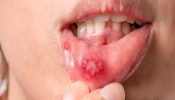 White Blister Risk : वारंवार तोंडाला फोड येणं हे गंभीर आजाराचं लक्षण, &#039;या&#039; कारणांमुळे येतं तोंड 