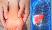 Signs Of Fatty Liver: फॅटी लिव्हरची समस्या असल्यास पायांमध्ये दिसतात &#039;हे&#039; बदल; जाणून घ्या लक्षणं