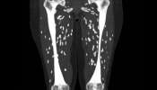 CT Scan च्या रिपोर्टमध्ये दिसले गुडघ्यातले किडे; आहारातील &#039;या&#039; चुकीमुळं ओढावलं संकट