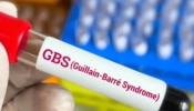 Guillain-Barre Syndrome: गिया बार्रे सिंड्रोमचा महाराष्ट्रात कहर! पुण्यात रुग्णसंख्या 130 वर