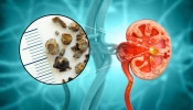 Kidney Stone च्या रुग्णांनी चुकूनही खाऊ नका 6 फळं; जीवावर बेतेल 