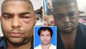 चेहऱ्यावर सूज, असह्य वेदना... हेअर ट्रान्सप्लान्ट केलेल्या इंजिनिअरने  आईच्या मांडीवर सोडला जीव