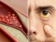 डोळ्यांमध्ये दिसतात High Cholesterol चा अलर्ट? डॉक्टरांनी सांगितले 4 संकेत, पाहता क्षणीच...