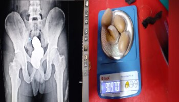 बापरे! पोटात दडवलं 42 लाखांचं सोनं, विमानतळावर असा झाला खुलासा