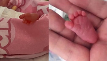 4 महिन्यातच डिलीव्हरी, जन्मावेळी 328 ग्रॅम वजन; आईच्या तळहातावर मावायची चिमुरडी,पुढे जे झालं...