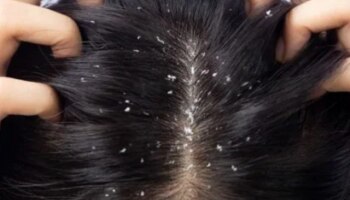 कोंड्यामुळे डोक्यात सारखी खाज येते ? &#039;हे&#039; घरगुती उपाय करून तर पाहा 