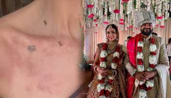 लग्नानंतर प्रियंका चोप्राच्या वहिनीच्या त्वचेवर आले लाल चट्टे, पोस्ट शेअर करत व्यक्त केल्या वेदना