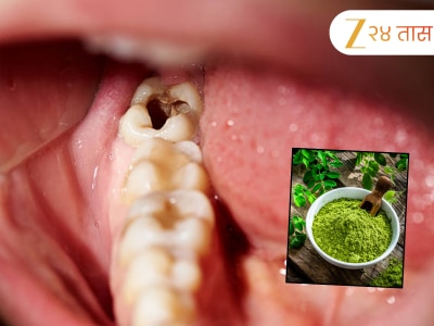 Teeth Cavity : दातांमधील किड, काळा डाग अन् दुर्गंधीने हैराण आहात? एका चिमुटभर आयुर्वेदिक पावडरने होईल कायमची सुटका 