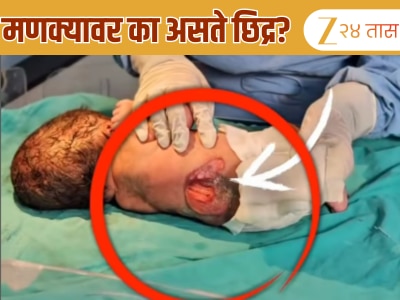 जन्मतःच बाळाच्या पाठीवर छिद्र; आईच्या एका चुकीमुळे नवजात बाळाची &#039;ही&#039; अवस्था; डॉक्टरांनी सांगितलं कारण 
