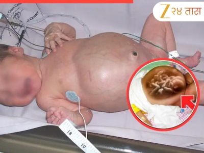 एका नवजात बाळाने दिला जुळ्या मुलांना जन्म! निसर्गाचा हा चमत्कार कसा घडला?  जाणून घ्या