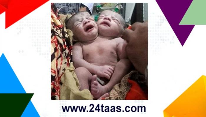 दोन मुंडक्यांचे बांग्लादेशी बाळ पाहून डॉक्टर हादरले 