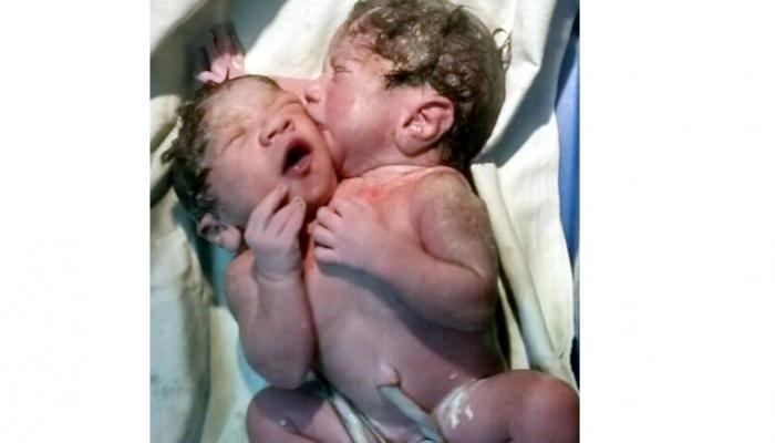 सायन रुग्णालयामध्ये दोन तोंडाच्या बाळाचा जन्म...