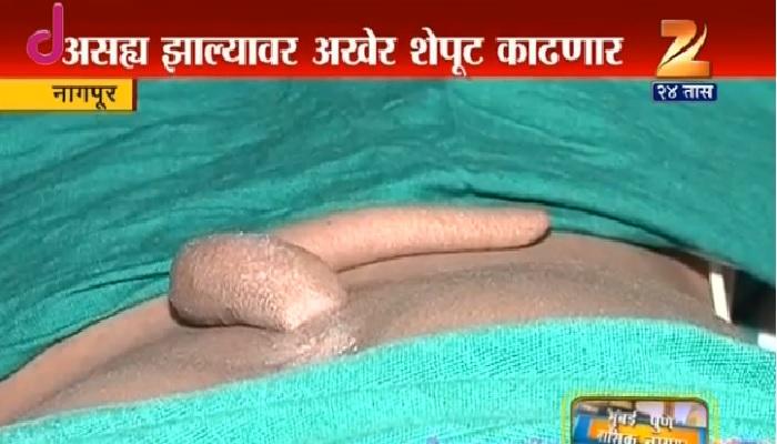 १८ वर्षाच्या तरूणाला १९ सेमी लांबींची शेपूट