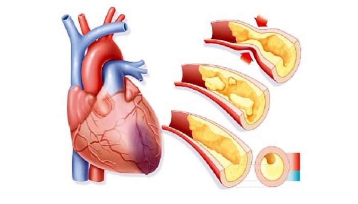  स्टेट बँकेच्या कॅशियर हार्टचा अॅटकने मृत्यू