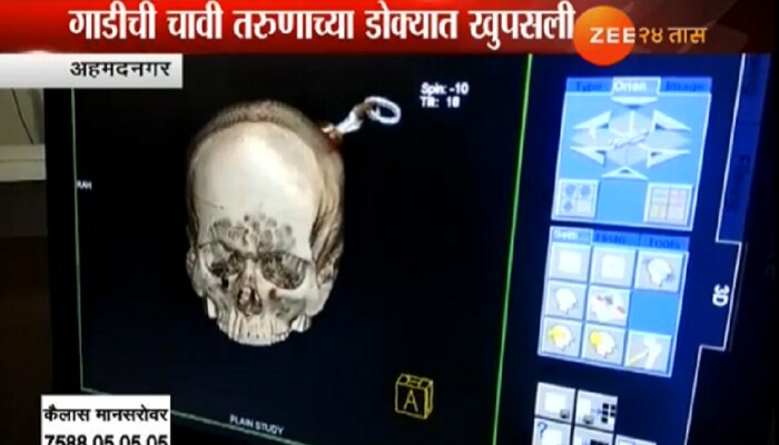 कवटी फोडून मेंदूपर्यंत चावी घुसली डोक्यात