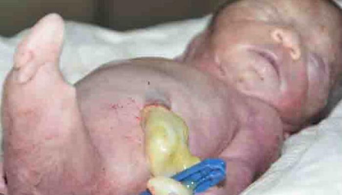 मर्मेड सिंड्रोम : बीडमध्ये जन्माला आलं दुर्मिळ आजाराचं बाळ