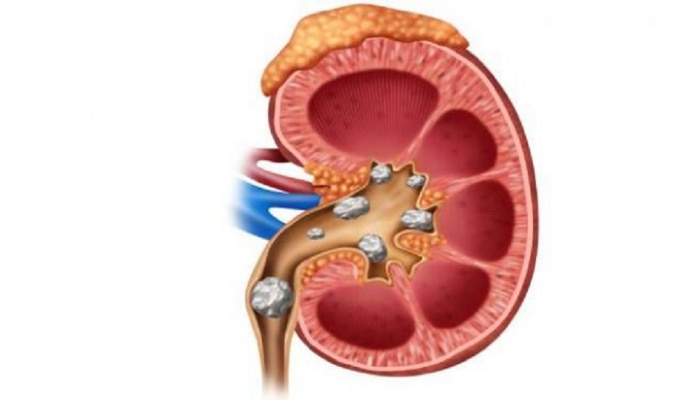 किडनी स्टोनची समस्या गंभीर करतील हे ६ पदार्थ!