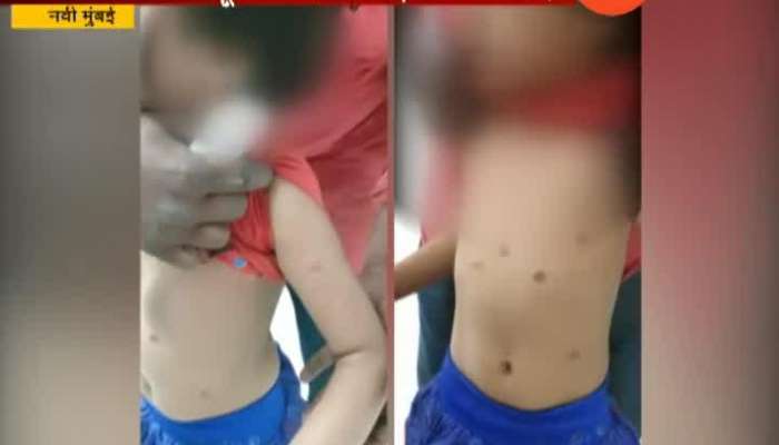 Navi Mumbai Five Year Old Punished By Candle Burn For Doing Mischief