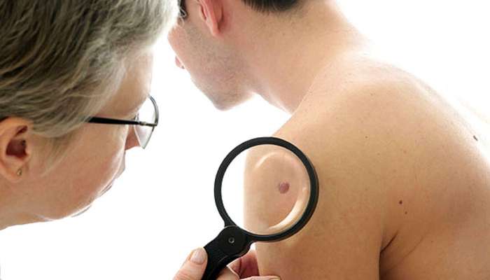 Candida Auris : भारतात पसरतोय हा जीवघेणा संसर्गजन्य रोग