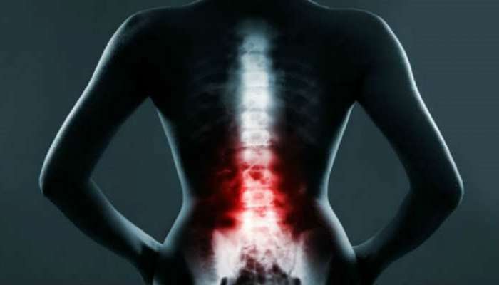 Ankylosing Spondylitis:कमरेचे किरकोळ दुखणे दुर्लक्षित करू नका 