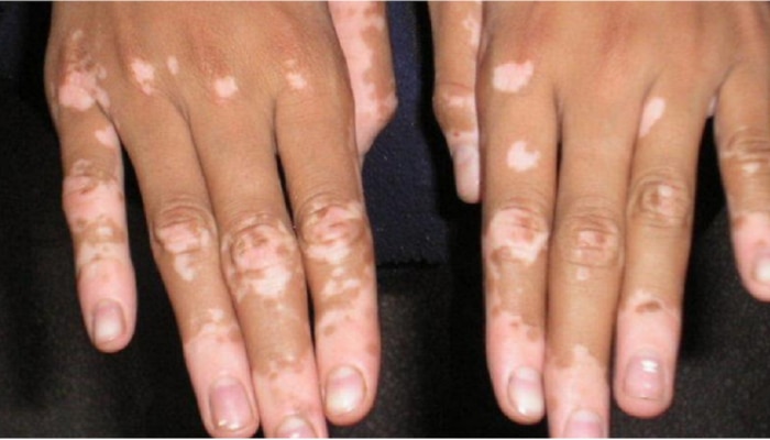 World Vitiligo Day: पांढऱ्या कोडावर उपचार होवू शकतात
