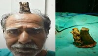 माणसाच्या डोक्यावर उगवलं शिंग